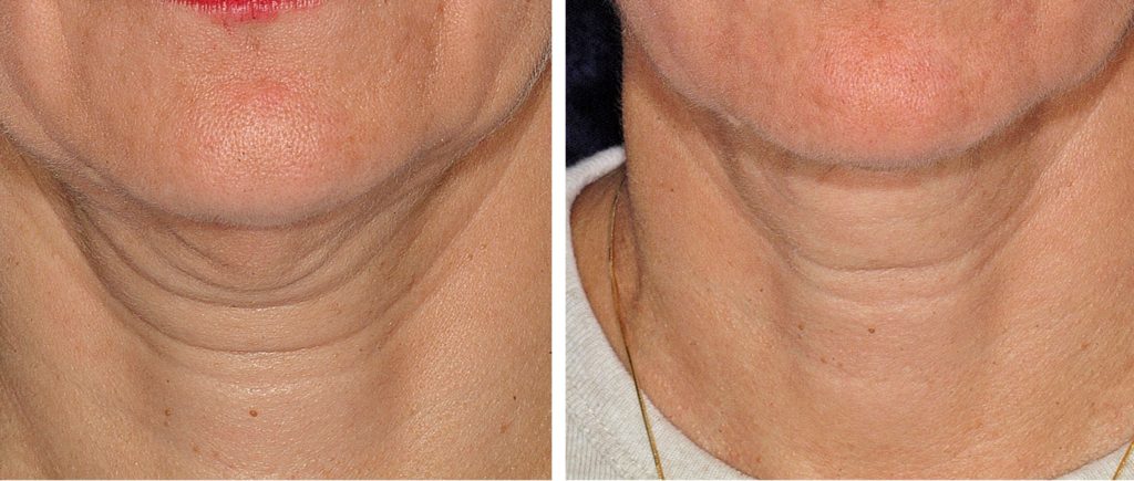 Thermage Neck Before And After Thermage Before And After