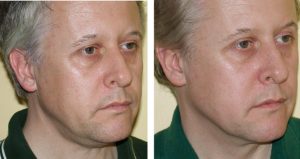 thermage non surgical face lift man